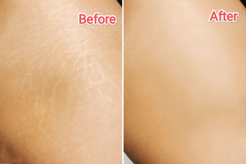 Stretch Mark Removal Georgia