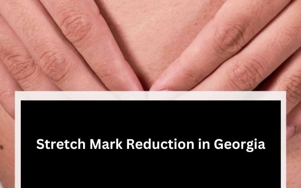 Stretch Mark Reduction in Georgia Effective Treatments